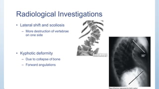 Radiological Investigations
• Lateral shift and scoliosis
– More destruction of vertebrae
on one side
• Kyphotic deformity
– Due to collapse of bone
– Forward angulations
 