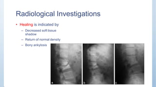 Radiological Investigations
• Healing is indicated by
– Decreased soft tissue
shadow
– Return of normal density
– Bony ankylosis
 