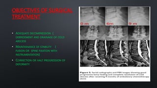 OBJECTIVES OF SURGICAL
TREATMENT
• ADEQUATE DECOMPRESSION (
DEBRIDEMENT AND DRAINAGE OF COLD
ABSCESS
• MAINTAINANCE OF STABILITY (
FUSION OR SPINE FIXATION WITH
INSTRUMENTATION)
• CORRECTION OR HALT PROGRESSION OF
DEFORMITY
 