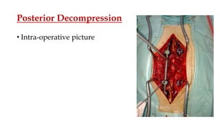 Posterior Decompression
• Intra-operative picture
 