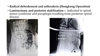 • Radical debridement and arthrodesis (Hongkong Operation)
• Laminectomy and posterior stabilisation – indicated in spinal
tumor syndrome and paraplegia resulting from posterior spinal
disease.
 