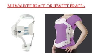 MILWAUKEE BRACE OR JEWETT BRACE:-
 