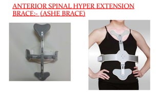 ANTERIOR SPINAL HYPER EXTENSION
BRACE:- (ASHE BRACE)
•
 
