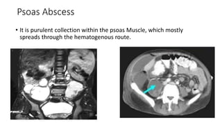 Psoas Abscess
• It is purulent collection within the psoas Muscle, which mostly
spreads through the hematogenous route.
 