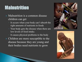    Malnutrition is a common disease
    children can get
    ◦ It occurs when your body can’t absorb the
      right amounts of nutrients in foods
    ◦ Your body gets the disease when there are
      low levels of food intake.
    ◦ It causes physical problems to the body
   Children are more susceptible to the
    disease because they are young and
    their bodies need nutrients to grow
 