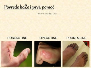 Povrede koŽe i prva pomoć
POSEKOTINE OPEKOTINE PROMRZLINE
Tamara Radičev VII3
 