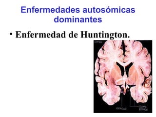 Enfermedades autosómicas
dominantes
• Enfermedad de Huntington.
 