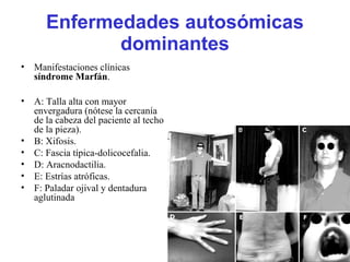 Enfermedades autosómicas
dominantes
• Manifestaciones clínicas
síndrome Marfán.
• A: Talla alta con mayor
envergadura (nótese la cercanía
de la cabeza del paciente al techo
de la pieza).
• B: Xifosis.
• C: Fascia típica-dolicocefalia.
• D: Aracnodactilia.
• E: Estrías atróficas.
• F: Paladar ojival y dentadura
aglutinada
 