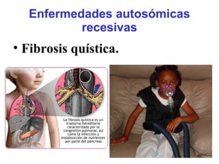 Enfermedades autosómicas
recesivas
• Fibrosis quística.
 