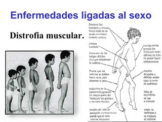 Enfermedades ligadas al sexo
Distrofia muscular.
 