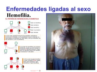 Enfermedades ligadas al sexo
Hemofilia.
 