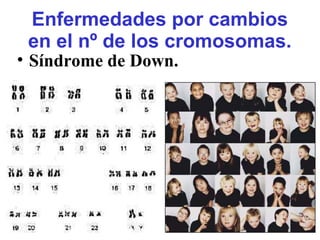 Enfermedades por cambios
en el nº de los cromosomas.
• Síndrome de Down.
 