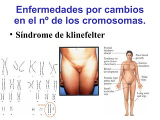 Enfermedades por cambios
en el nº de los cromosomas.
• Síndrome de klinefelter
 