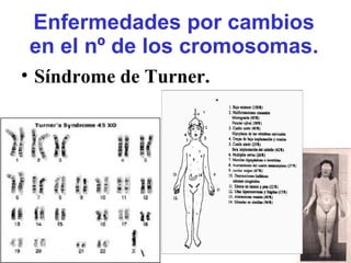Enfermedades por cambios
en el nº de los cromosomas.
• Síndrome de Turner.
 