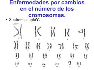 Enfermedades por cambios
en el número de los
cromosomas.
• Síndrome duploY.
 