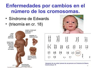 Enfermedades por cambios en el
número de los cromosomas.
• Síndrome de Edwards
• (trisomía en cr. 18)
 