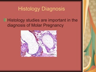 Histology Diagnosis Histology studies are important in the diagnosis of Molar Pregnancy 