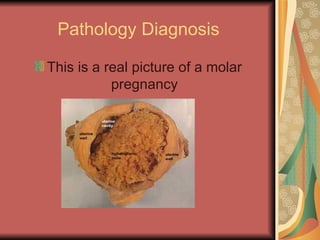 Pathology Diagnosis This is a real picture of a molar pregnancy 