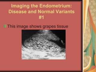 Imaging the Endometrium: Disease and Normal Variants #1 This image shows grapes tissue 