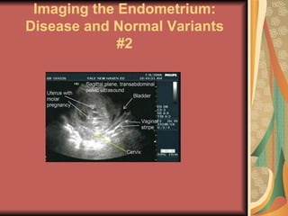 Imaging the Endometrium: Disease and Normal Variants #2 