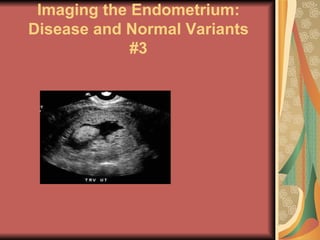 Imaging the Endometrium: Disease and Normal Variants #3 