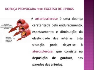 A arteriosclerose é uma doença 
caraterizada pelo endurecimento, 
espessamento e diminuição da 
elasticidade das artérias. Esta 
situação pode dever-se à 
aterosclerose, que consiste na 
deposição de gordura, nas 
paredes das artérias. 
 