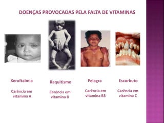 Xeroftalmia 
Carência em 
vitamina A 
Raquitismo 
Carência em 
vitamina D 
Pelagra 
Carência em 
vitamina B3 
Escorbuto 
Carência em 
vitamina C 
 