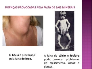 O bócio é provocado 
pela falta de iodo. 
A falta de cálcio e fósforo 
pode provocar problemas 
de crescimento, ossos e 
dentes. 
 