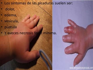 •   Los síntomas de las picaduras suelen ser:
•    dolor,
•   edema,
•   vesícula,
•   pústula
•   Y aveces necrosis focal mínima.
 