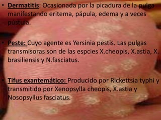 • Dermatitis: Ocasionada por la picadura de la pulga
  manifestando eritema, pápula, edema y a veces
  pústula.

• Peste: Cuyo agente es Yersinia pestis. Las pulgas
  transmisoras son de las espcies X.cheopis, X.astia, X.
  brasiliensis y N.fasciatus.

• Tifus exantemático: Producido por Rickettsia typhi y
  transmitido por Xenopsylla cheopis, X.astia y
  Nosopsyllus fasciatus.
 