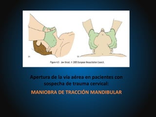 Apertura de la vía aérea en pacientes con
sospecha de trauma cervical:
MANIOBRA DE TRACCIÓN MANDIBULAR
 