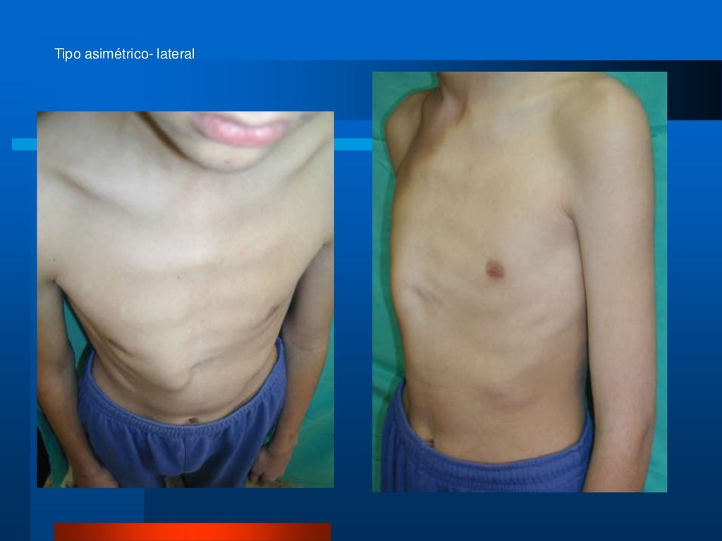Pectus Carinatum