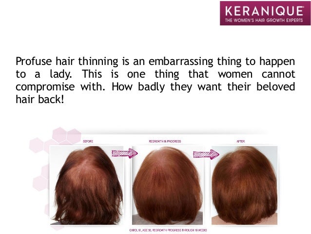 Powerful Hair Loss Treatment For Women