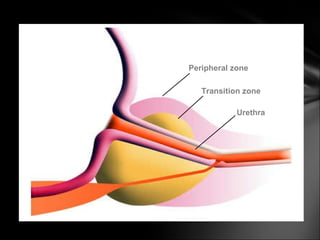 Peripheral zone Transition zone Urethra 