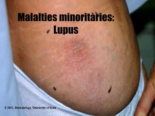 Malalties minoritàries: Lupus 