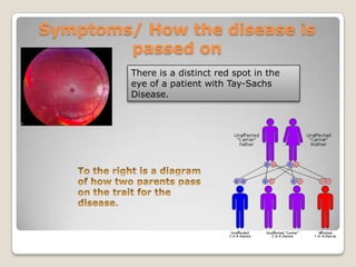 Tay-Sachs Disease