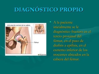 DIAGNÓSTICO PROPIO  A la paciente inicialmente se le diagnóstico fractura en el tercio proximal del fémur, en el paso de diafisis a epífisis, en el extremo inferior de los trocantes ubicados en la cabeza del fémur. 