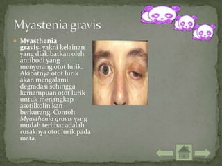  Myasthenia
 gravis, yakni kelainan
 yang diakibatkan oleh
 antibodi yang
 menyerang otot lurik.
 Akibatnya otot lurik
 akan mengalami
 degradasi sehingga
 kemampuan otot lurik
 untuk menangkap
 asetilkolin kan
 berkurang. Contoh
 Myasthenia gravis ysng
 mudah terlihat adalah
 rusaknya otot lurik pada
 mata.
 
