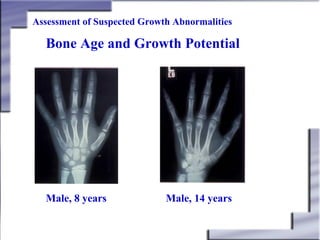 Assessment of Suspected Growth Abnormalities

Bone Age and Growth Potential

Male, 8 years

Male, 14 years

 