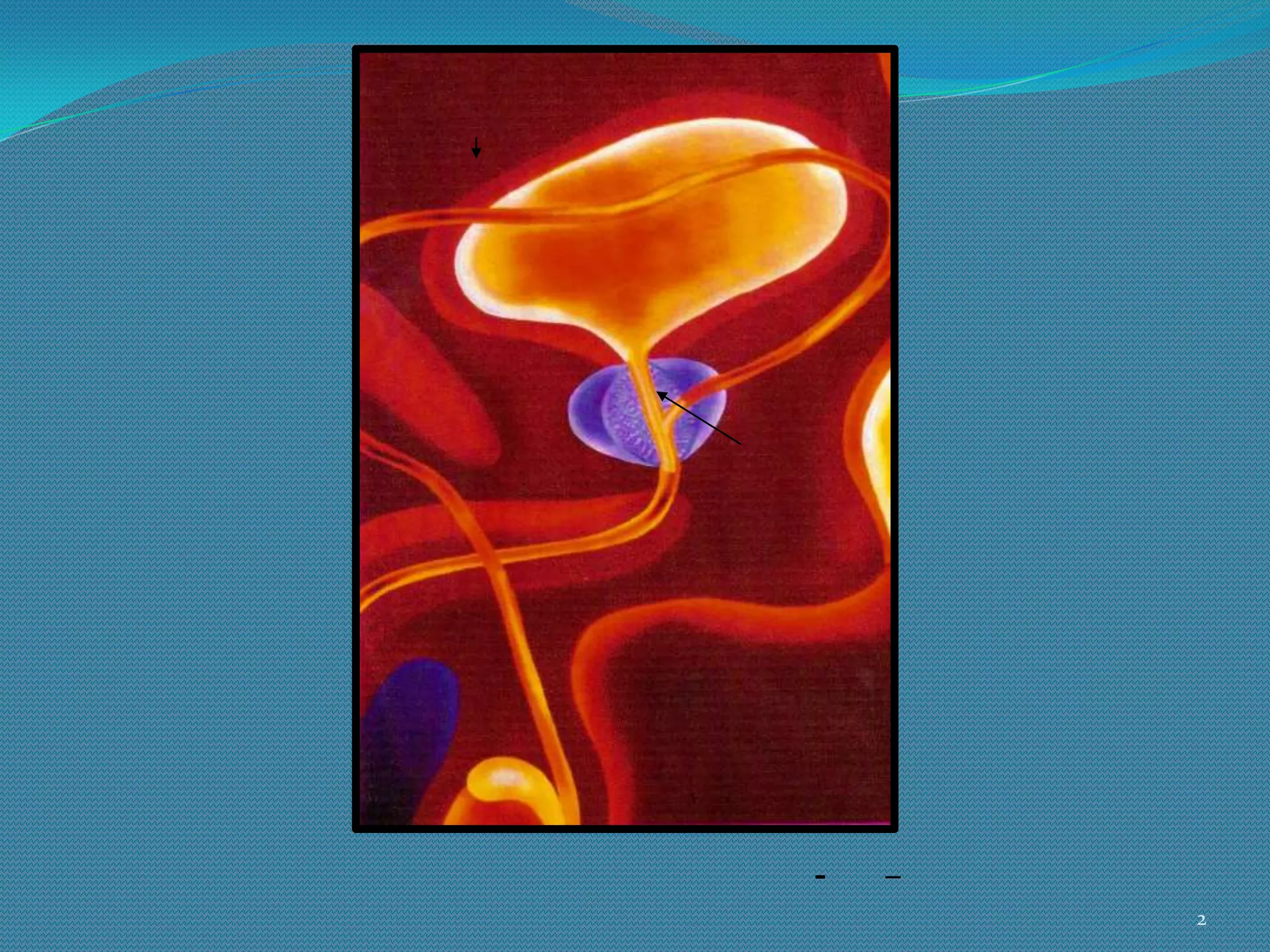 Benign Prostatic Enlargement (BPE) | PPT