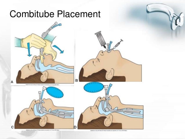 Power point airway management