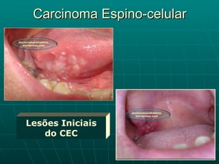 Carcinoma Espino-celular Lesões Iniciais do CEC 