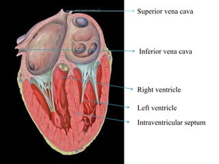Superior vena cava 
Inferior vena cava 
Right ventricle 
Left ventricle 
Intraventricular septum 
 