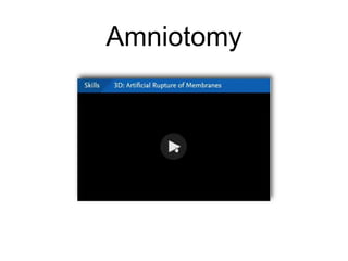 Amniotomy
 