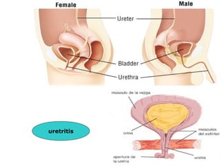 uretritis
 