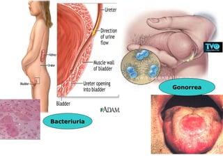 Gonorrea




Bacteriuria
 
