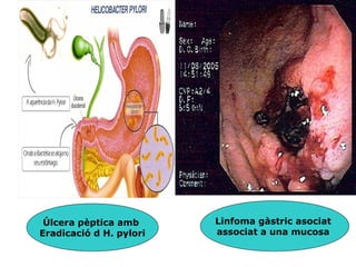 Úlcera pèptica amb      Linfoma gàstric asociat
Eradicació d H. pylori   associat a una mucosa
 