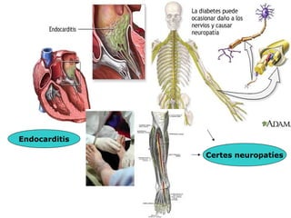 Endocarditis

               Certes neuropatíes
 