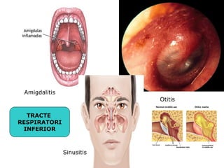 Amigdalitis
                           Otitis

  TRACTE
RESPIRATORI
 INFERIOR



               Sinusitis
 