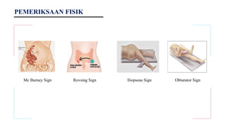 PEMERIKSAAN FISIK
Mc Burney Sign Rovsing Sign Iliopsoas Sign Obturator Sign
 